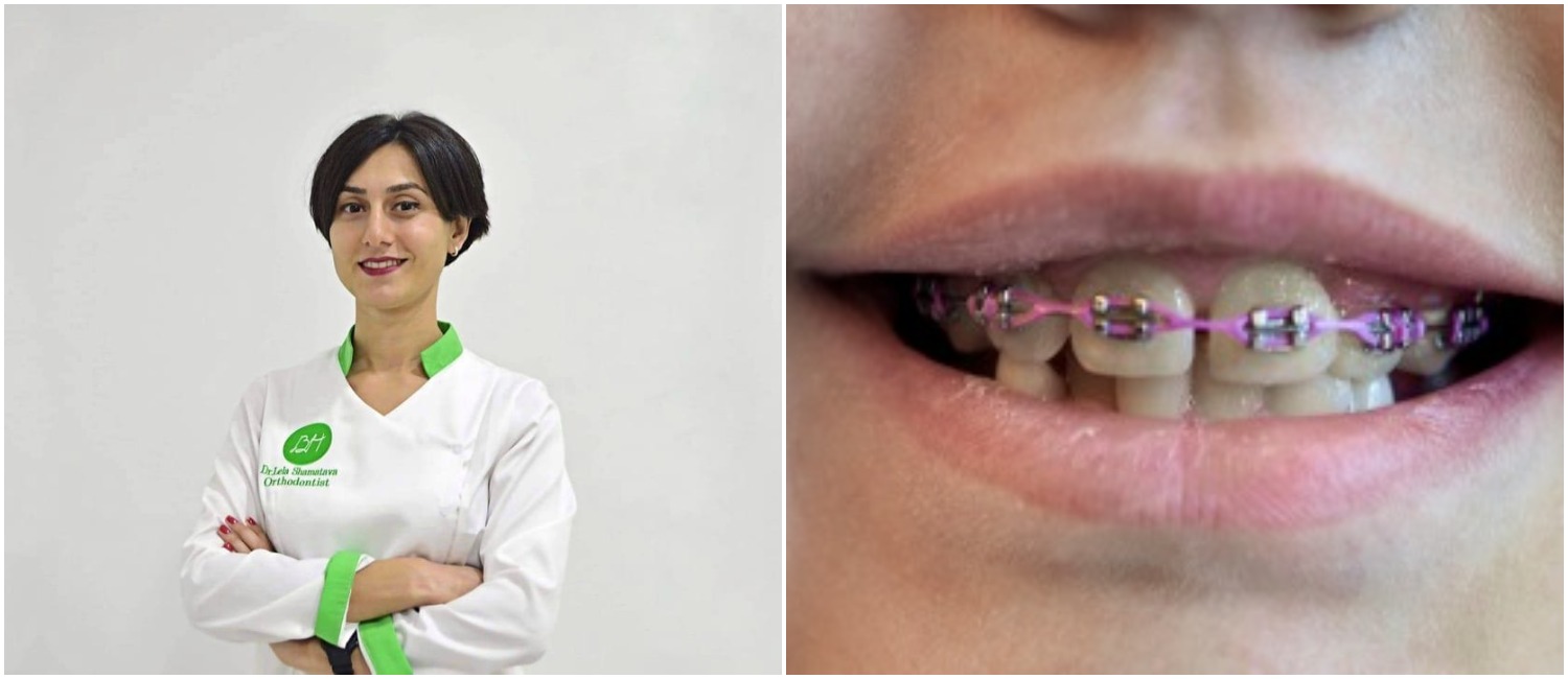 5-6 წლის ასაკში სასურველია, კბილებს შორის იყოს სივრცეები - გაეცანით ექიმ-ორთოდონტის რეკომენდაციებს MOMSEDU.GE-ზე